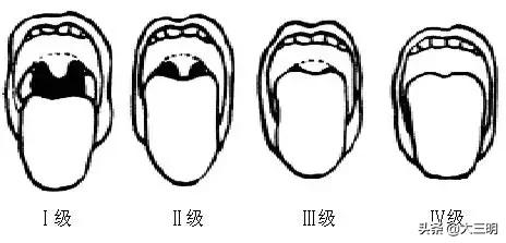 医疗•技术｜三明市永安总医院麻醉医师成功征服困难气道，助力妇科微创手术