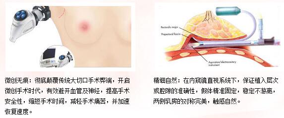 宁波假体隆胸维持时间,蓝贝假体隆胸维持多久