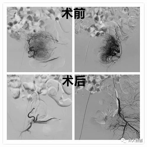 子宫肌瘤6cm可以怀孕吗,当怀孕遇到了乙肝该怎么办