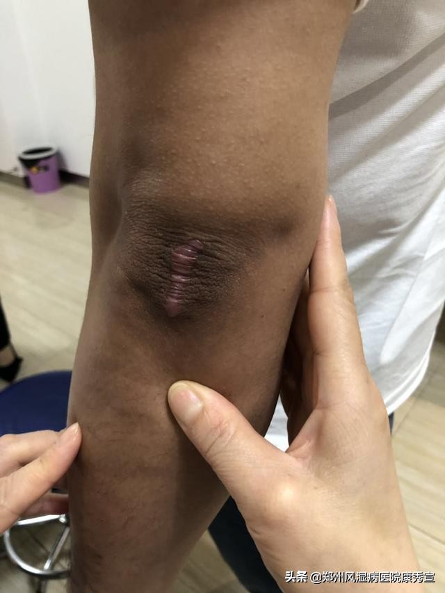 痛风发作怎么可以快速缓解,痛风突然发作怎么样可以马上止痛