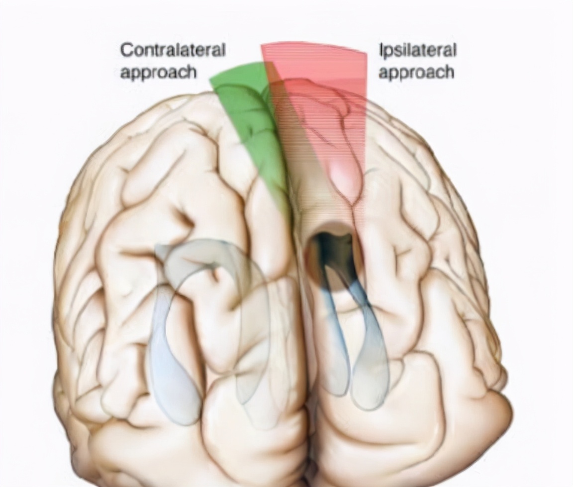 INC巴特朗菲教授视频|视神经-下丘脑胶质瘤全切案例集及治疗解读