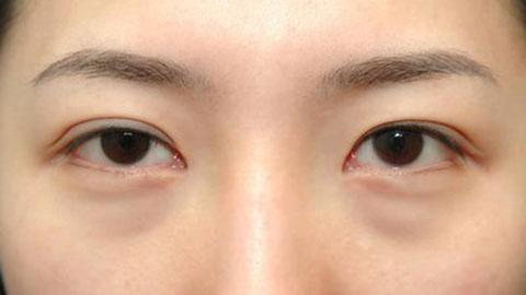 激光祛眼袋适合哪类人,生姜祛眼袋的正确方法