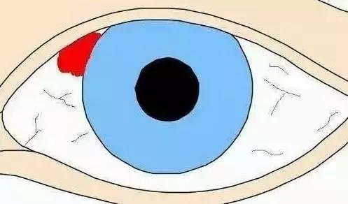 眼底出血是什么原因造成的怎么治,糖尿病眼底出血会发展成什么