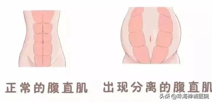 是否要做产后治疗,要不要做产后修复