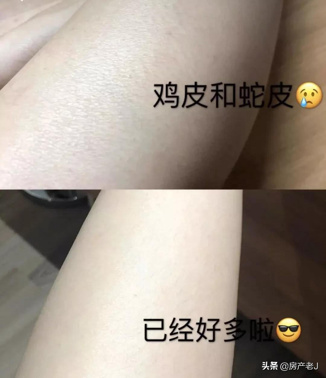 腿上有鱼鳞皮屑怎么办,腿上起皮屑就是鱼鳞病