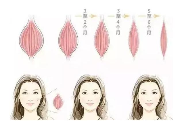 瘦脸针瘦脸详细讲解,瘦脸针瘦脸详细讲解图