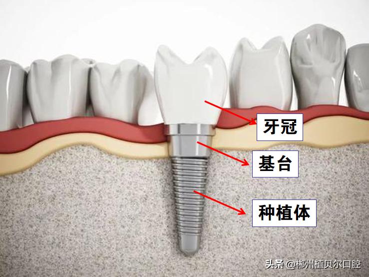现在最好的种植牙多少钱一颗,真实种植牙到底多少钱一颗