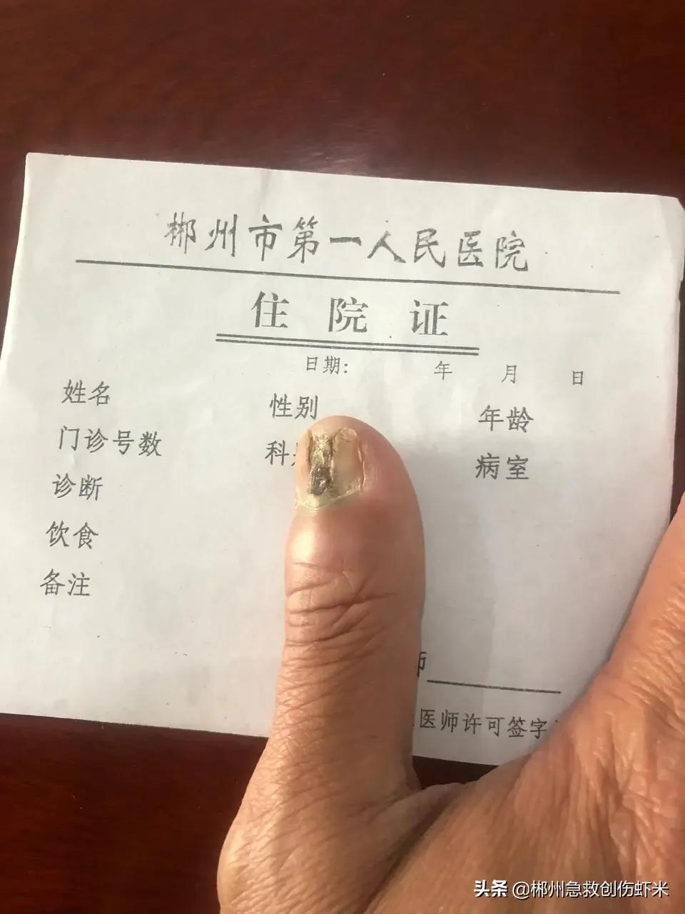 手指甲黑线怎么看是不是黑色素瘤,指甲有甲母痣会癌变吗