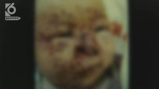 三个月婴儿被老鼠啃食后续,云南三个月女婴被群鼠咬