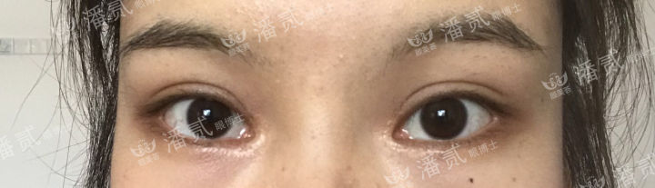 女孩眼部整形失败,内眼角整形失败