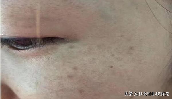 脸上长褐斑是什么原因如何解决,脸上褐斑越来越多怎么回事