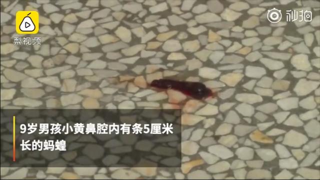 男童反复流鼻血竟是一条大蚂蝗,5岁男孩取出蚂蟥