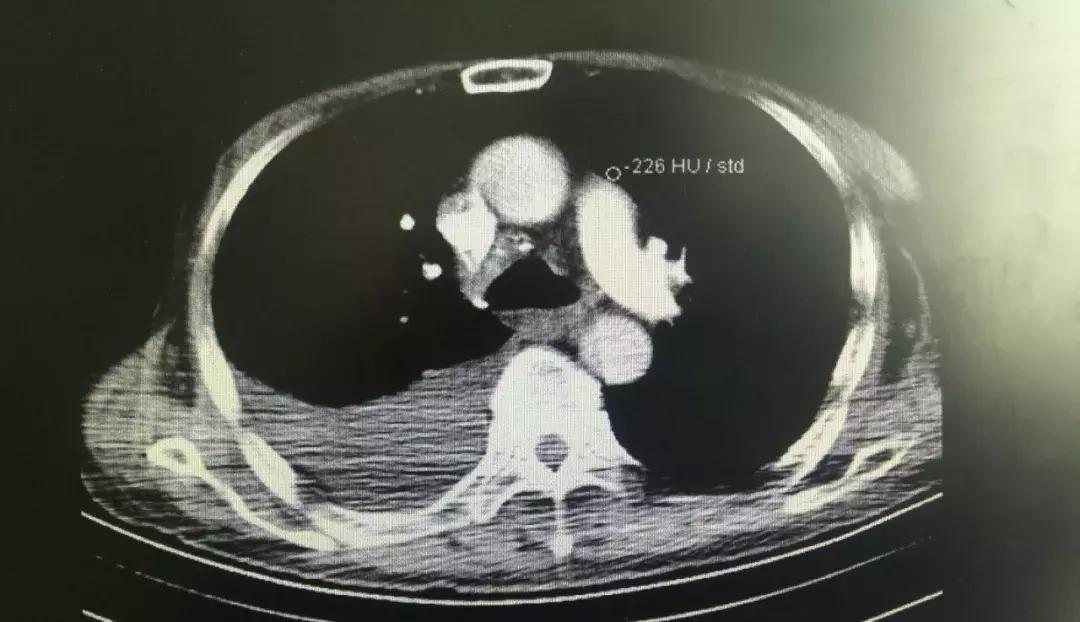 把病人的胸水当“宝贝”，医生亲自从青海护送到杭州！这么拼的吗？