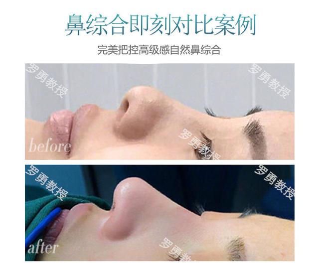 那些隆胸成功的人,那些隆鼻过的女人现在都怎么样了