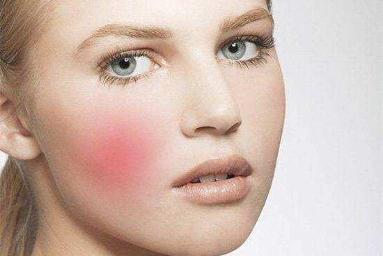 宝宝脸红有血丝角质层薄怎么解决,角质层有血丝用什么护肤品