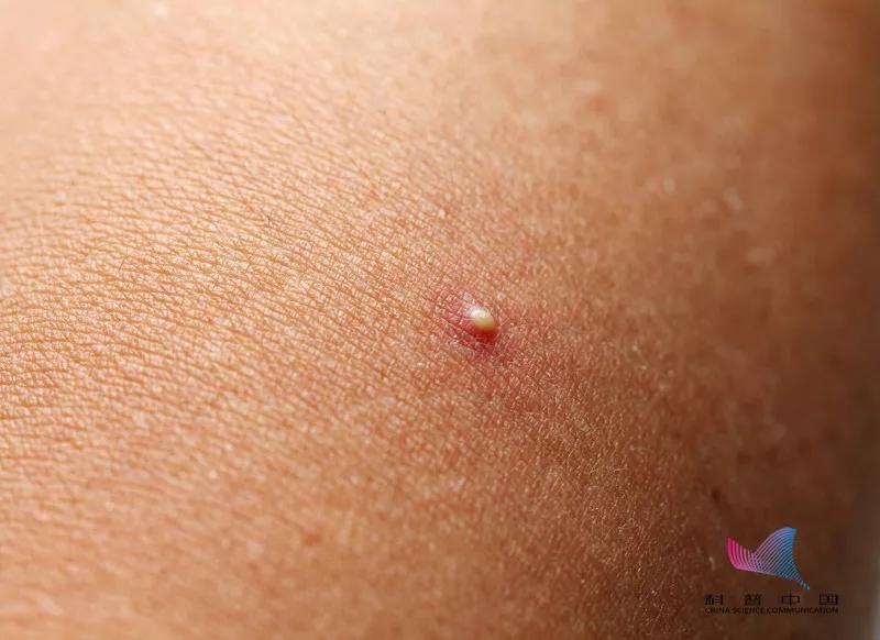 后背长小疙瘩什么原因怎么调理,后背脂肪疙瘩怎么去除