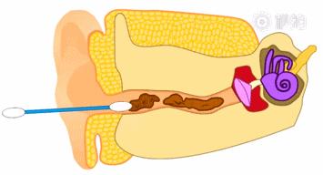耳科医生管掏耳朵吗,经常用棉签掏耳朵会有耳屎吗