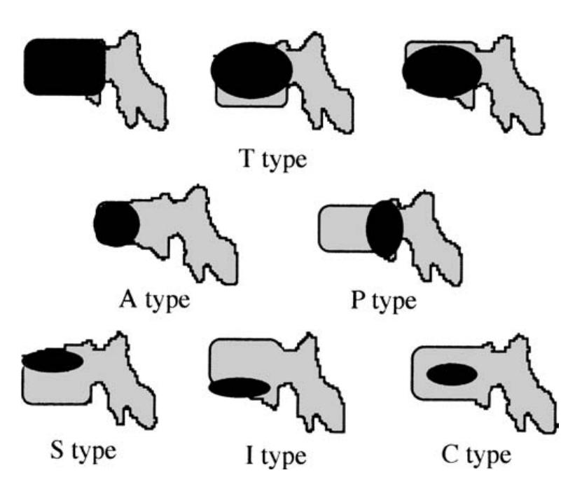 骨质疏松椎体压缩性骨折治疗指南,德国骨科骨质疏松骨折