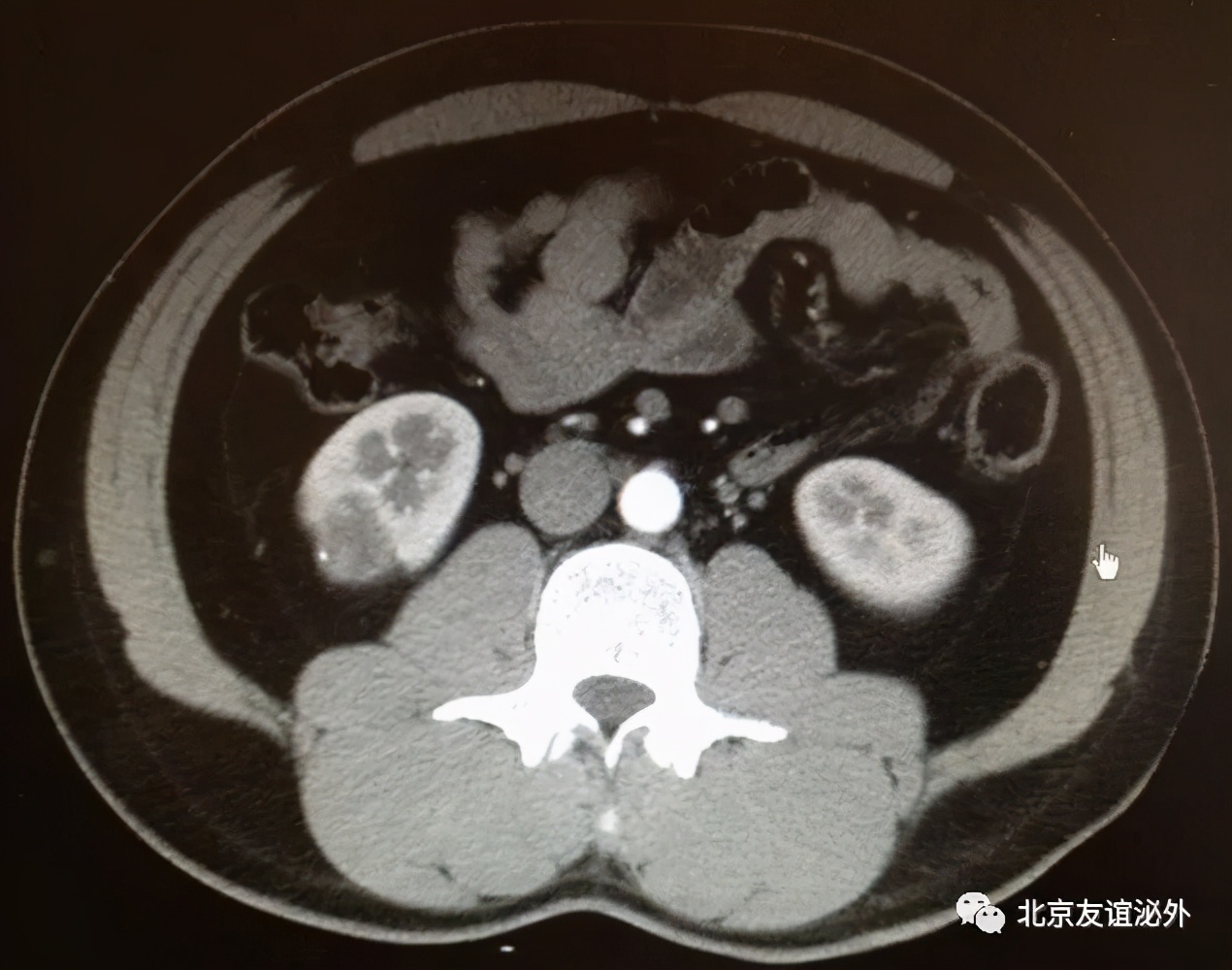 体检发现肾囊肿需不需要做手术,儿童体检发现肾囊肿