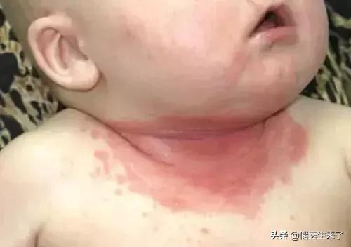 治疗儿童皮肤病的外用药,儿童皮肤病有哪些偏方