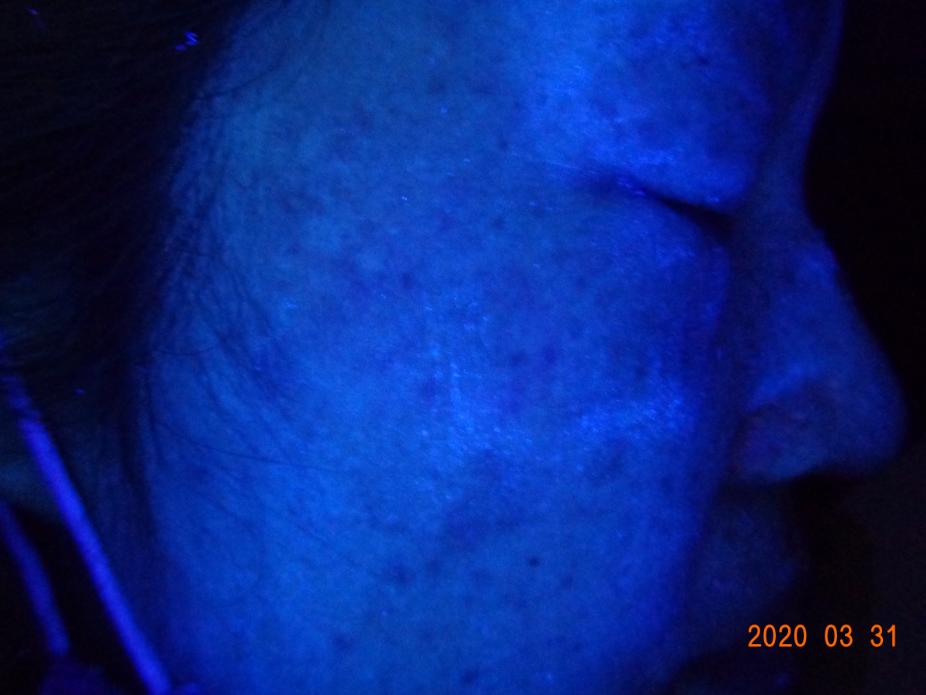 白癜风治愈一百例,白癜风治愈患者分享痊愈经验