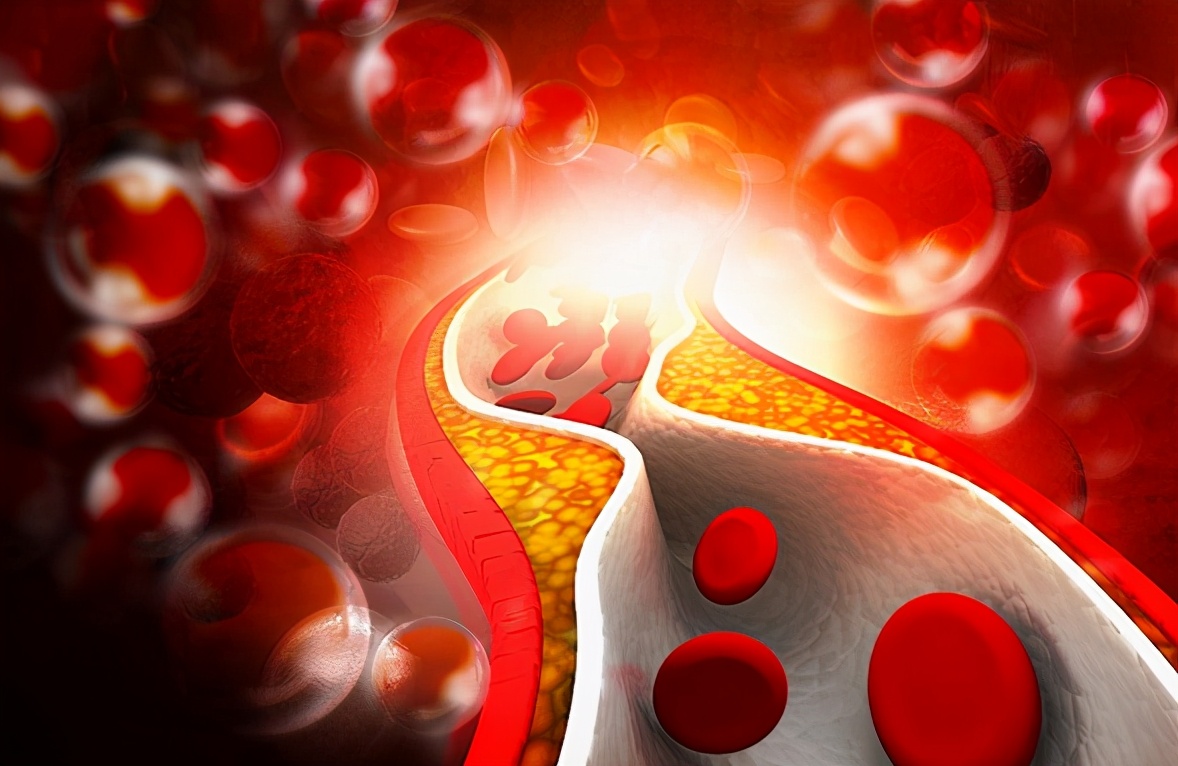 得了痔疮能吃蒜黄吗,得痔疮为什么不能吃辛辣刺激