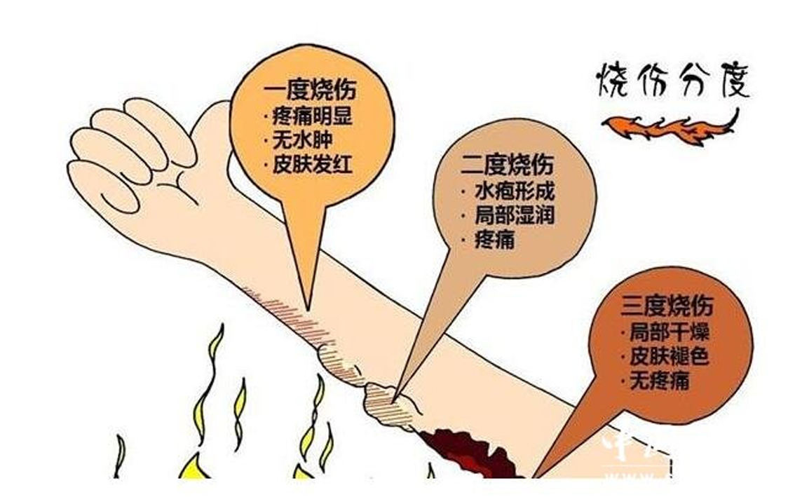 疫情期间儿童发烧怎么自救,儿童烧烫伤的早期防护及急救措施