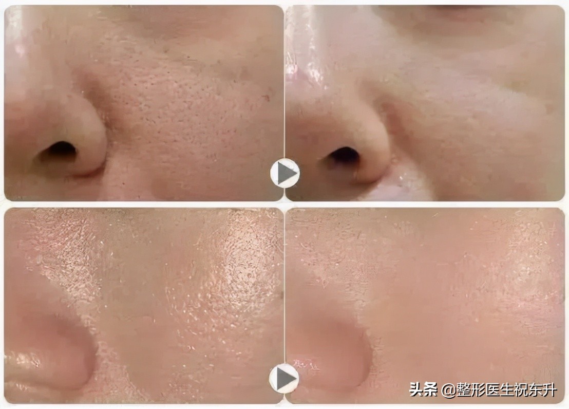 打完水光针皮肤特别油,韩国明星打完水光针的皮肤效果