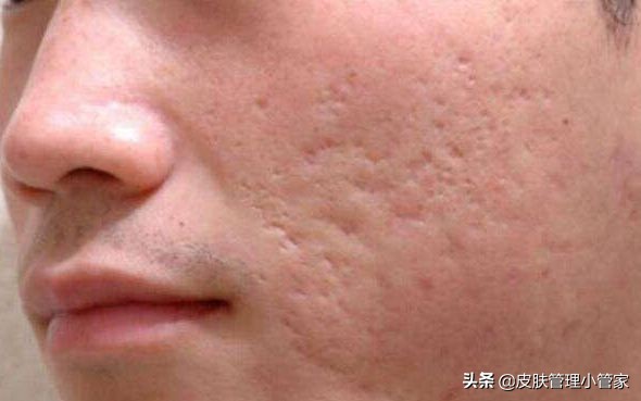 祛斑祛痘皮肤管理,皮肤管理祛痘有效吗