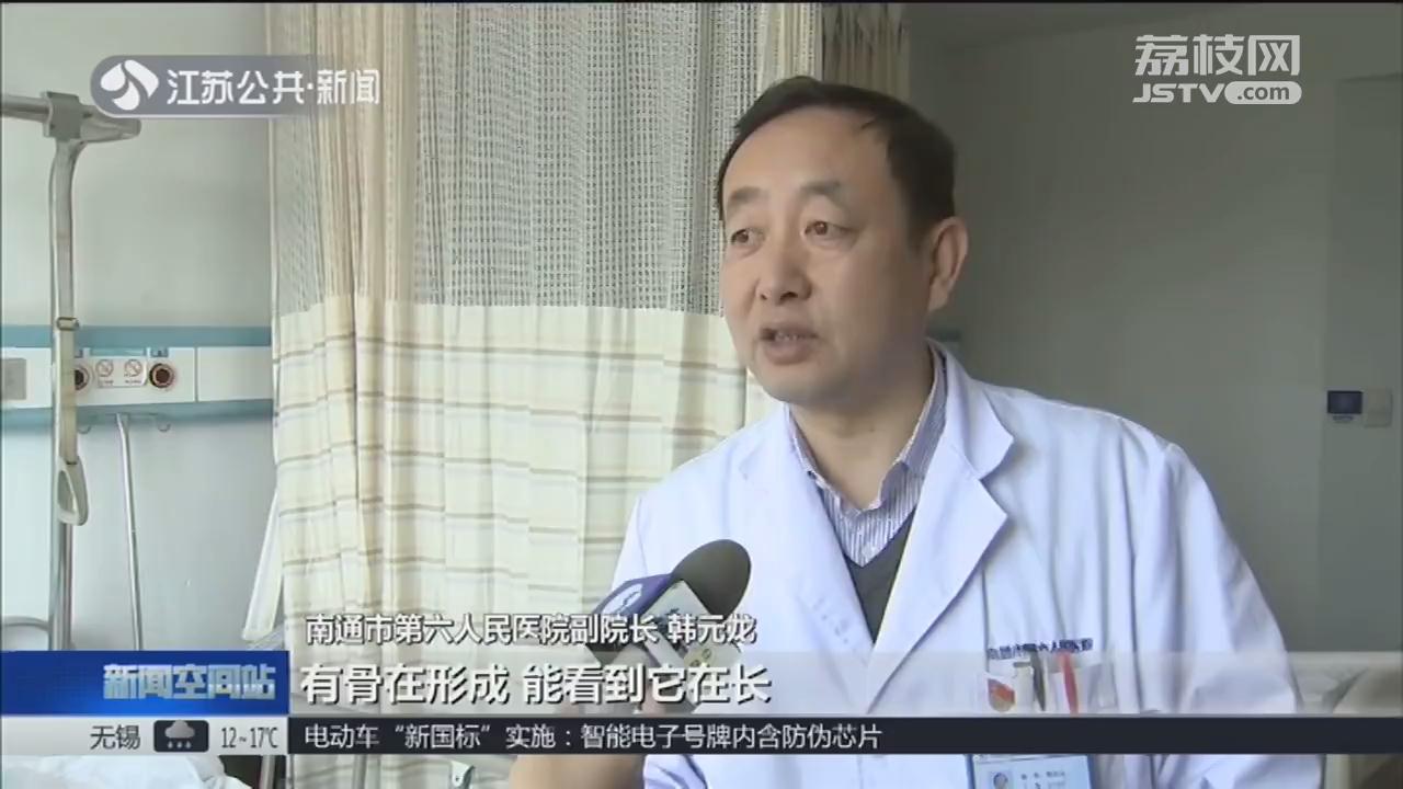 先髋截骨手术后腿会变长还是变短,右腿比左腿短2公分怎么办