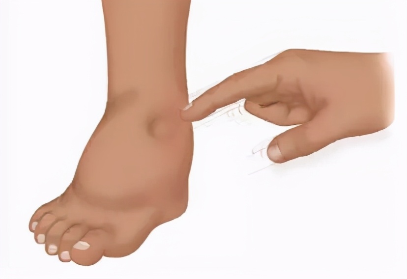 【慎之又肾】经常自我感觉“膨胀”？你可能是肿了