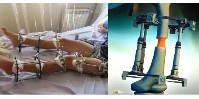 增高术三步骤大揭秘,增高治疗是骗人的吗