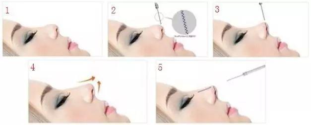 做了线雕隆鼻肿得厉害,女孩隆鼻鼻小柱溃烂