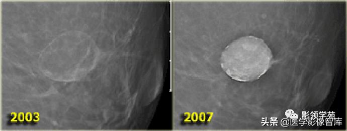 乳腺钙化怎么区分良性和恶性,乳腺钙化的诊断与分级
