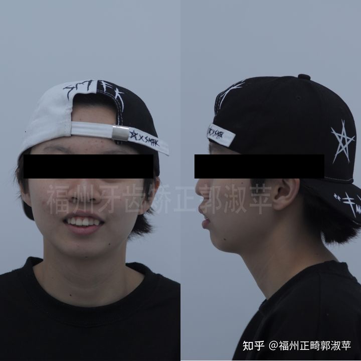 牙齿龅牙矫正过程全记录33岁,大龅牙牙齿矫正成功案例和费用