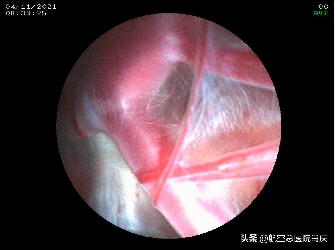 鞍上池蛛网膜囊肿手术费用,鞍上池蛛网膜囊肿影响智力吗