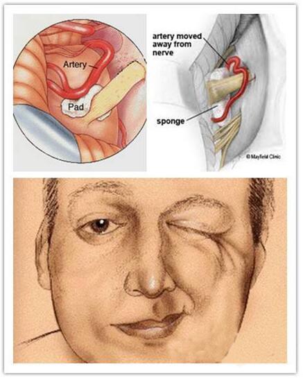 面肌痉挛是面瘫吗,中医治面肌痉挛