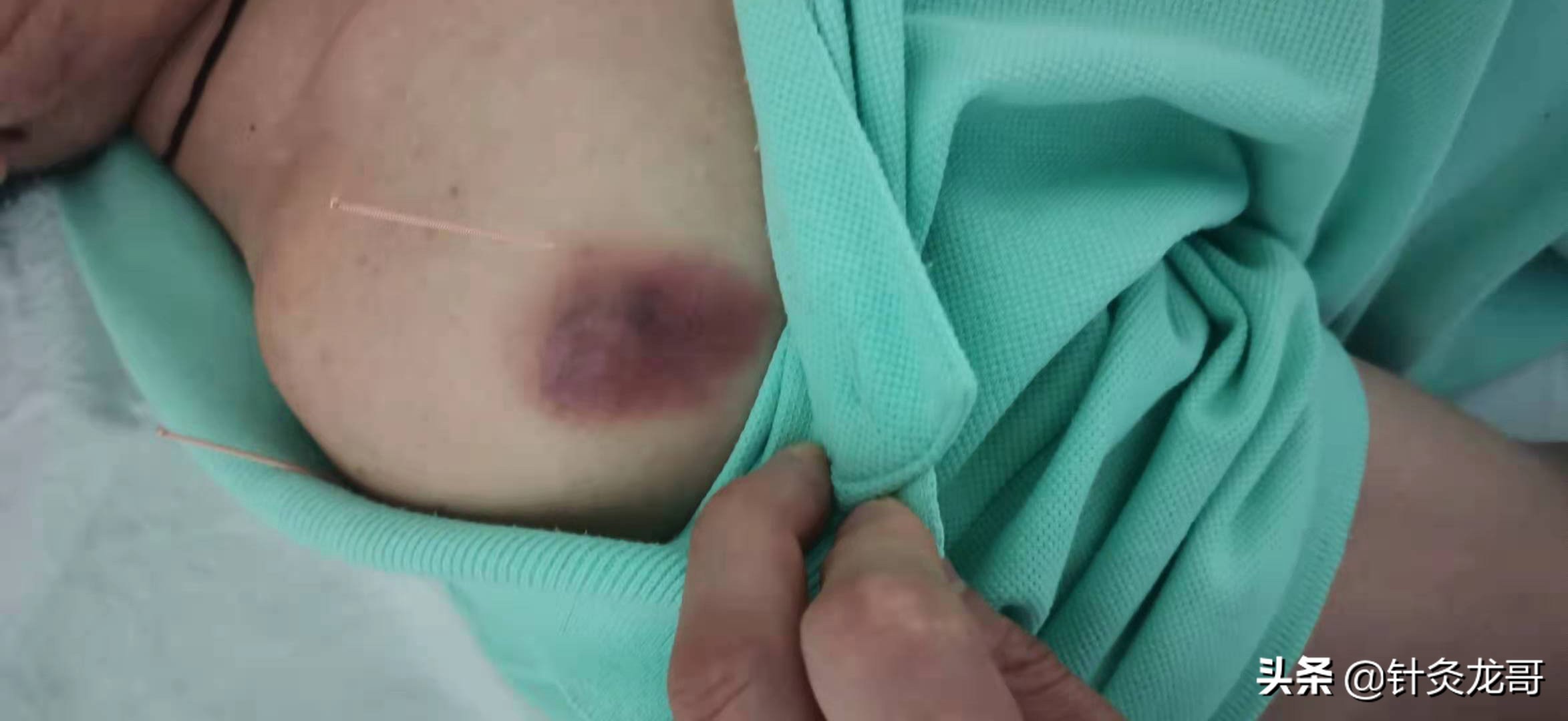 针灸出现淤青怎么办?会影响疗效吗?