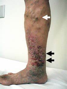 下肢静脉曲张出现皮疹用药,下肢瘙痒起疹子