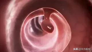 胃复春对肠息肉有治疗效果吗,家族性肠息肉病首选的治疗方式