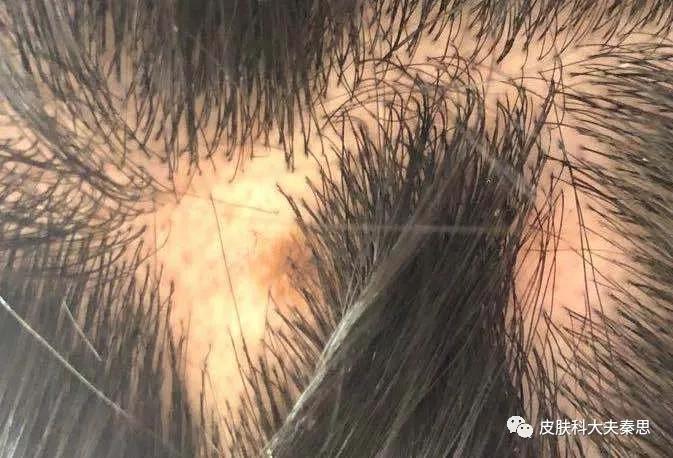 儿童头发掉了一大块怎么回事,梦到头发掉了一大块秃了