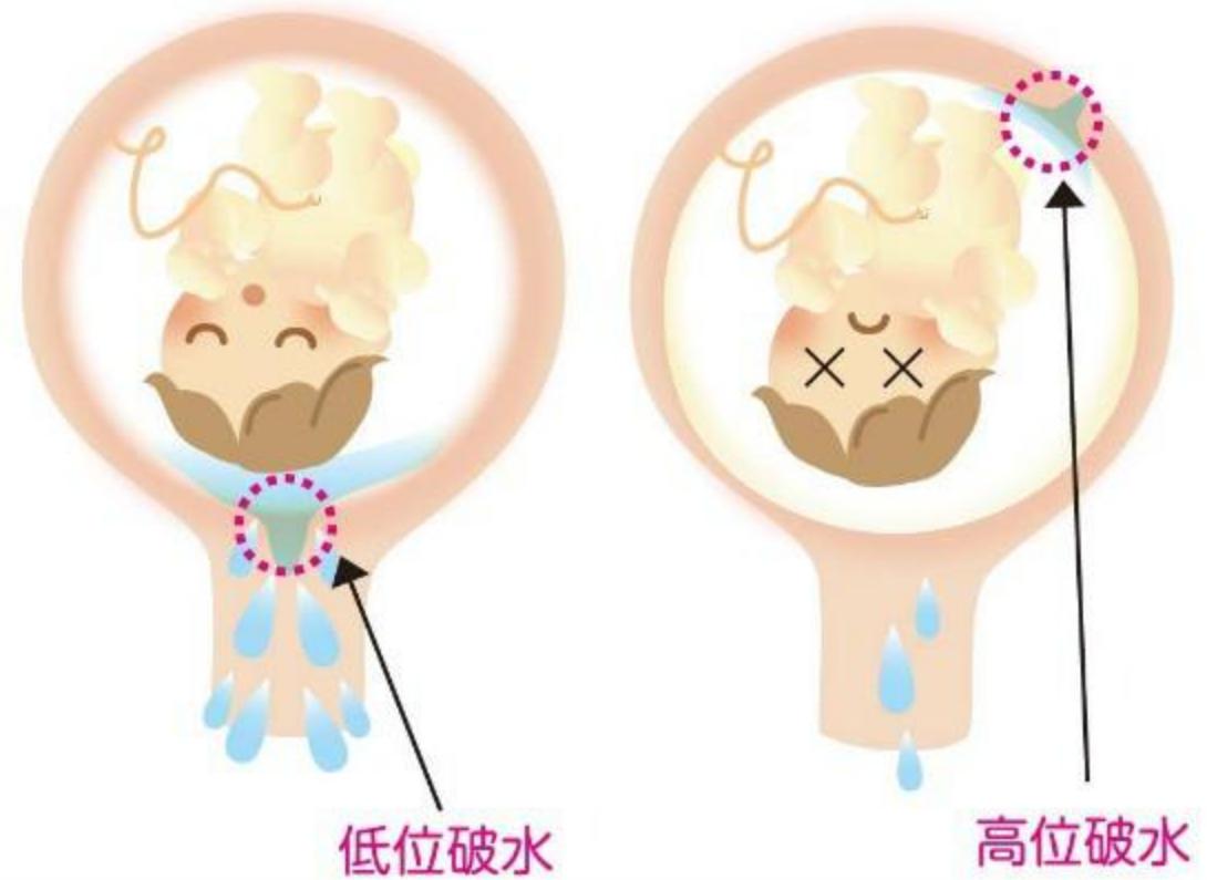 孕晚期足月出生注意事项,孕妇差不多需要提前进医院待产吗