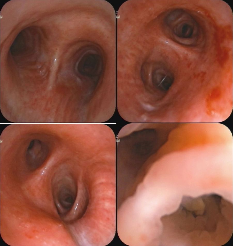 如何发现肺部真菌感染,怎样早期识别真菌感染