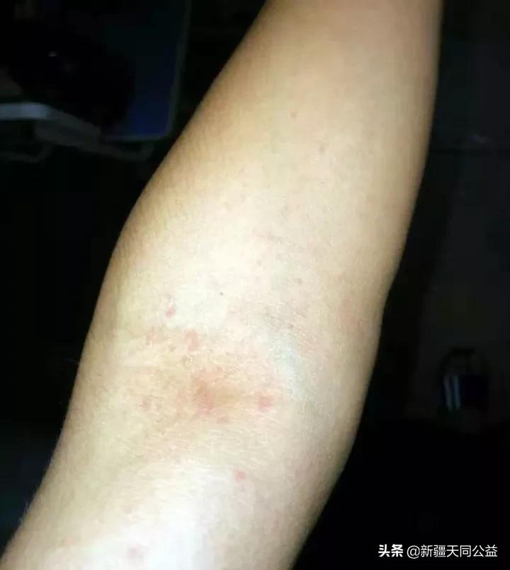 hiv服药二十年的真实感受,hiv服药二十五年的真实感受