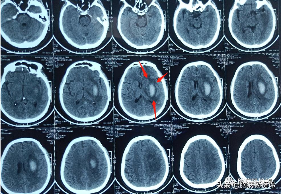 高空掉落脑出血,高处作业会不会引起脑溢血