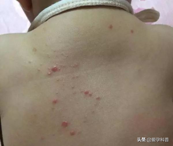 婴儿湿疹是胎毒引起的吗,宝宝长湿疹怎么表示自己不舒服