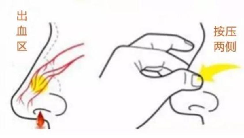 打喷嚏流鼻血有什么常用药,打喷嚏流鼻血用什么方法止血最快