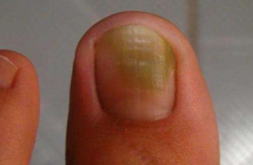 灰指甲加脚气加甲沟炎用什么泡脚,灰指甲脚气甲沟炎鸡眼挂什么科