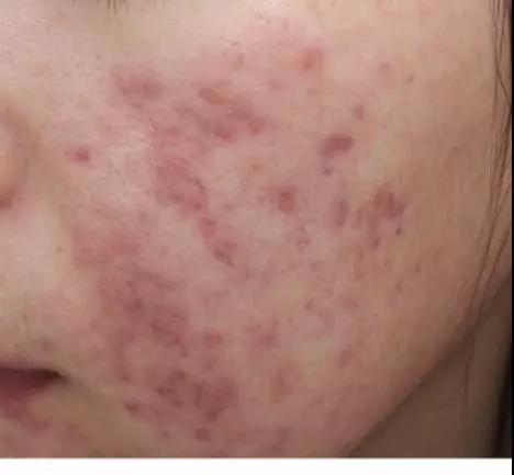 痘印淡化且不留痕迹方法男生,痘印有效去除