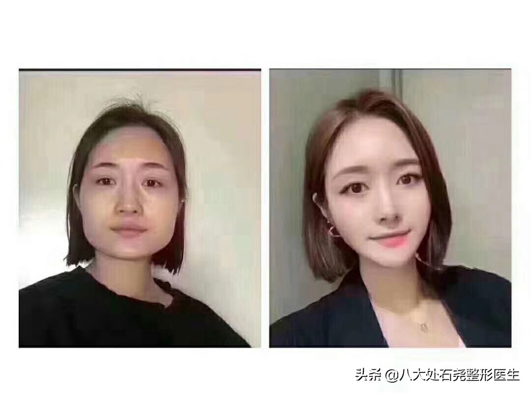 瘦脸针后苹果肌下垂凹陷能恢复吗,你有脸部下垂的烦恼吗